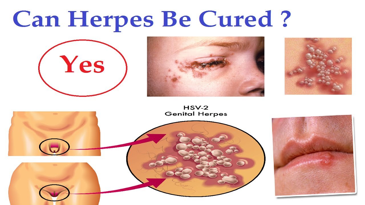 herpes cure, herpes treatment
